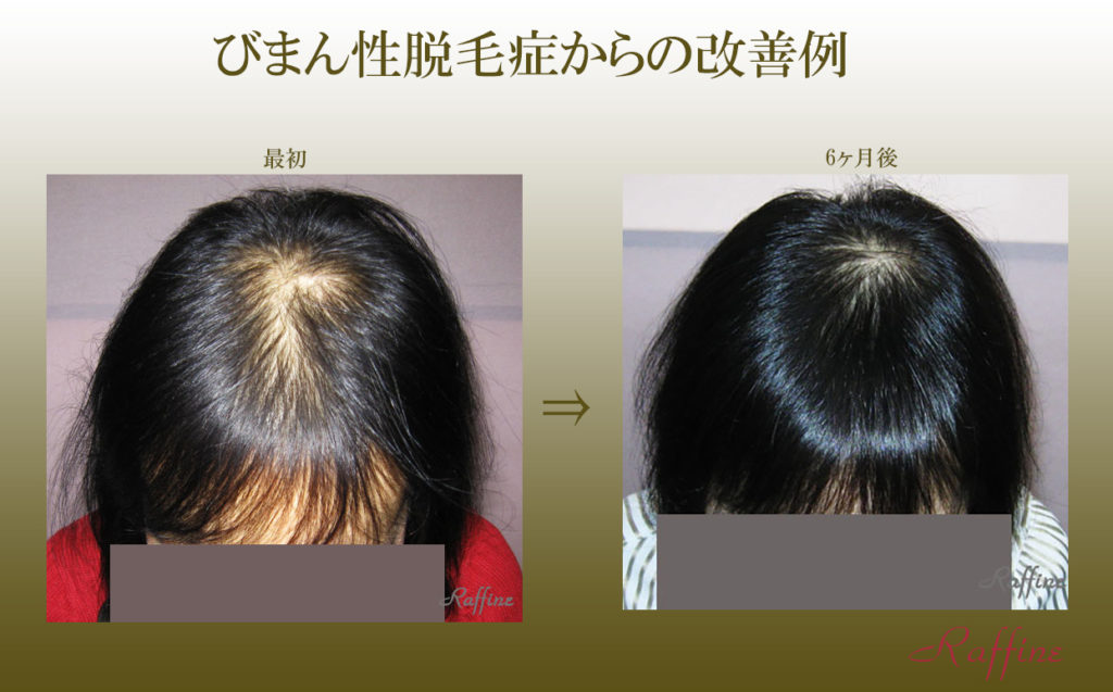 びまん性脱毛症からの改善例2 諦めないで！薄毛治療だけではない！ 白髪の改善や予防防止と育毛・発毛を実現するラ・フィーネ研究開発