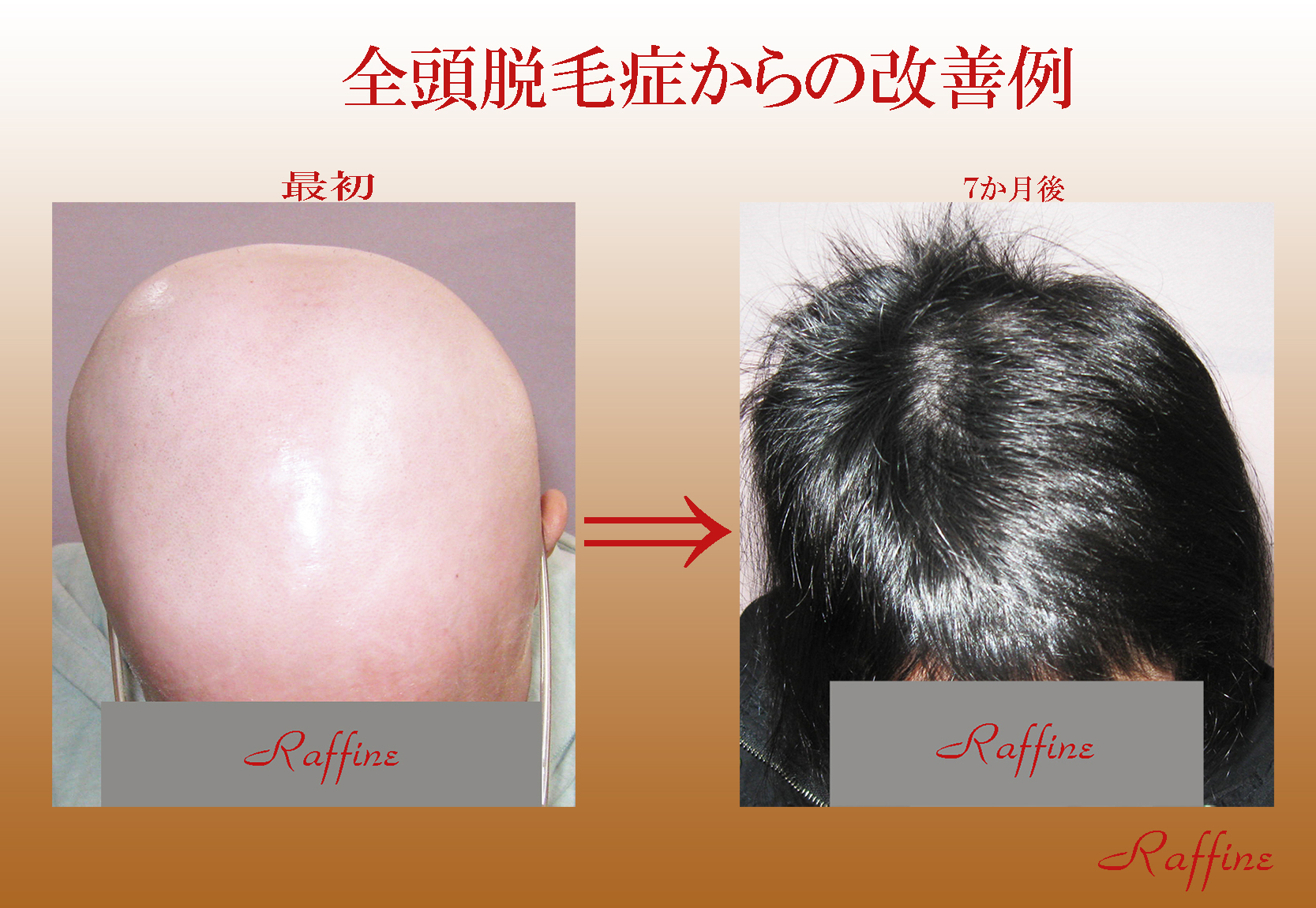 全頭脱毛症、一刻も早くケアを！頭皮のかぶれ湿疹等も、大きく悪影響を及ぼしますよ！ 白髪の改善や予防防止と育毛・発毛を実現するラ・フィーネ研究開発