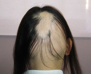 多発型円形脱毛症最初の状態