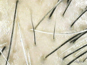 円形脱毛症 治療後悪化から元の状態に復活! | 白髪の改善や ...