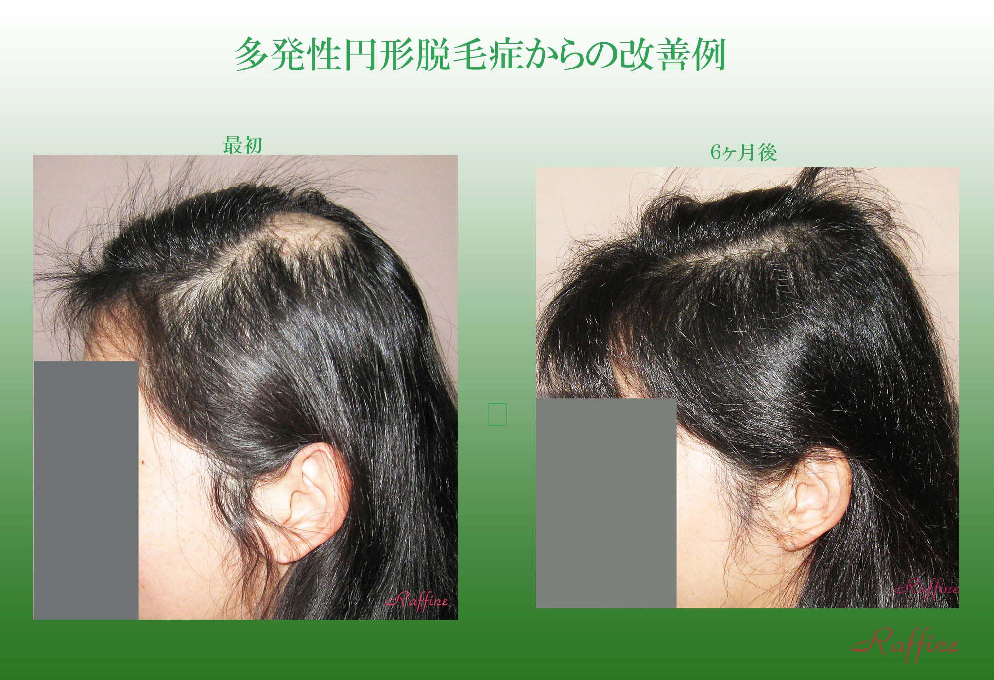 円形脱毛症・多発性円形脱毛症の改善例 特集2 白髪の改善や予防防止と育毛・発毛を実現するラ・フィーネ研究開発