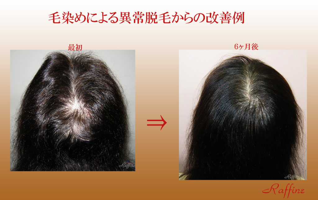 毛染めによる異常脱毛からの改善例