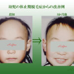 幼児の休止期脱毛症からの改善例